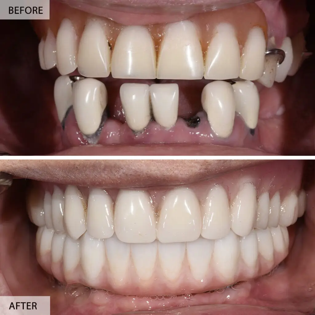 all on 4 before after 1 1024x1024