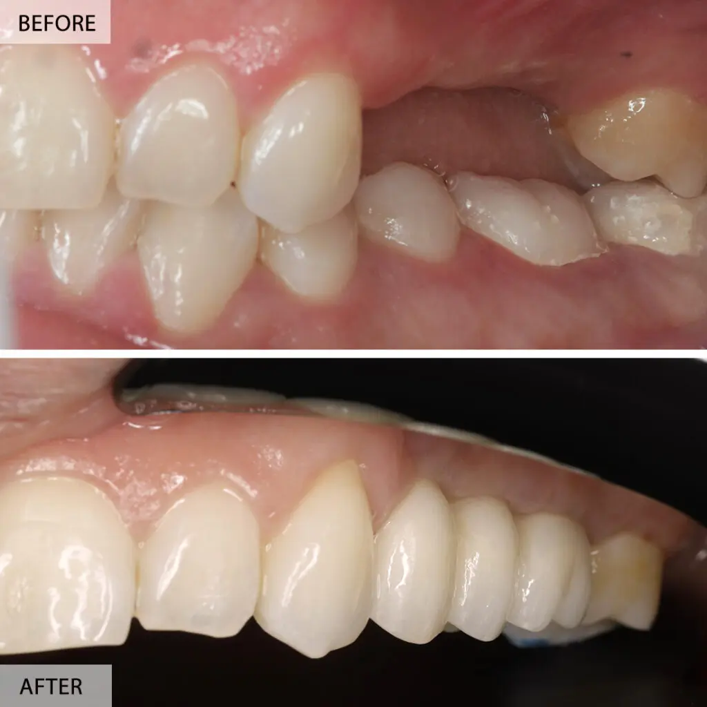 back teeth dental implants before after 1024x1024