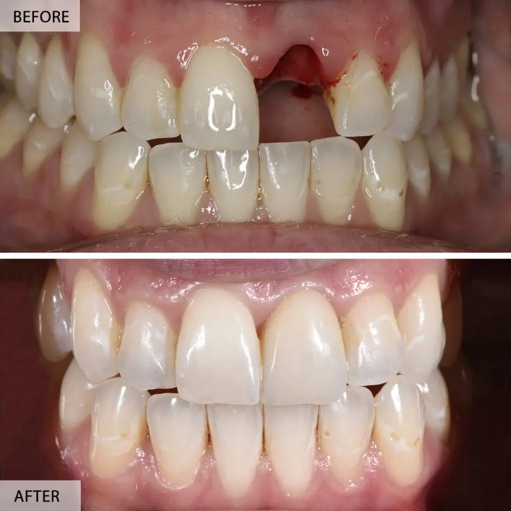 front tooth dental implant before after 1024x1024