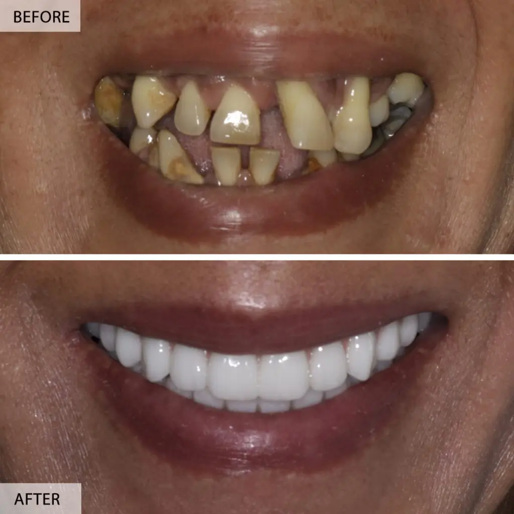 full mouth implant before after 1024x1024