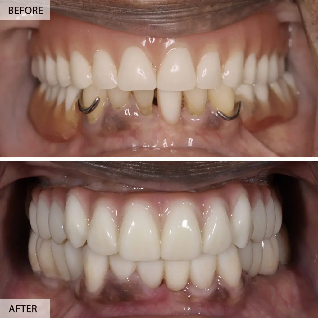 full mouth rehab before after 1024x1024