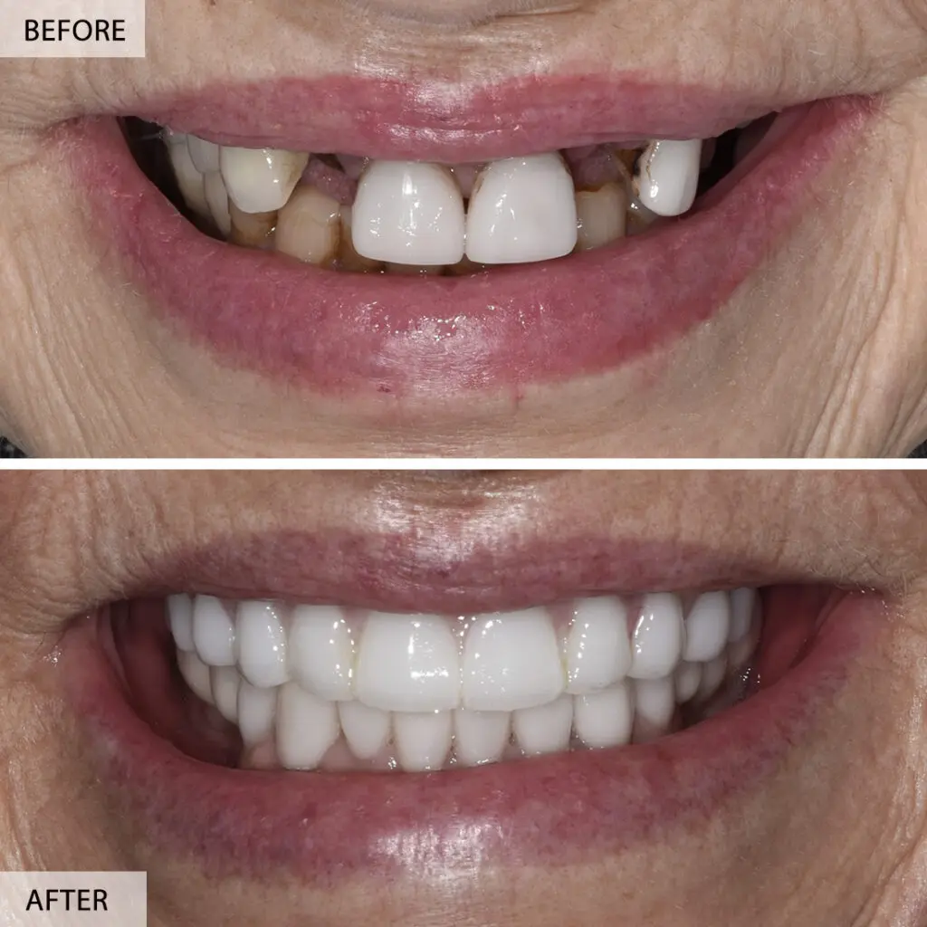сomplex implant cases before after 1024x1024